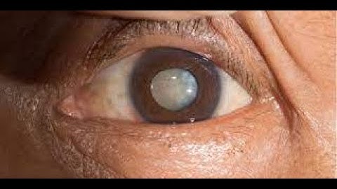 Discission of Cataract surgery CPT code - simplify medical coding