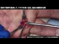動画4-1　ばね指の手術
