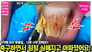 축구하면서 점점 심해지고 아파졌어요ㅠㅠ 진작에 관리받을걸.. 너무 편해요!!!^^ #내성발톱 #내성 #내성발톱교정 #무좀발톱 #발톱무좀 #발톱 #toenails #족보있는그녀들