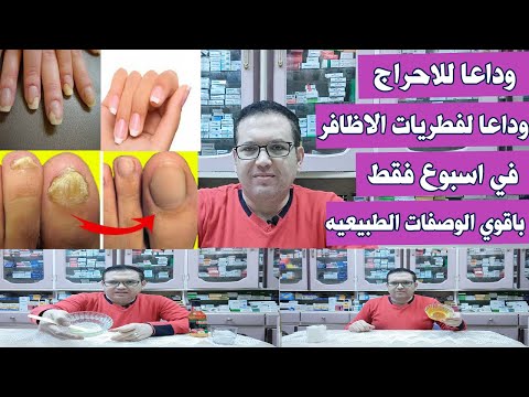 فيديو: 4 طرق لعلاج الأظافر المكسورة