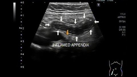 Ultrasound Video showing focusing of inflamed appendix.