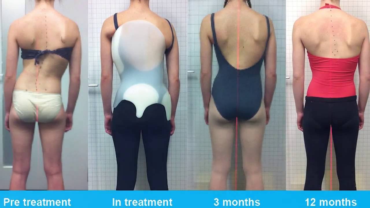 Airy scoliosis brace