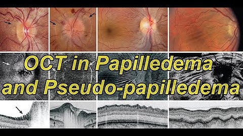 OCT in Papilledema and Pseudo-papilledema