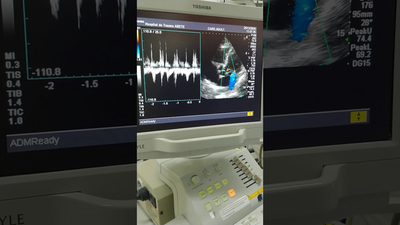 Predictor de respuesta a Volumen por Ecocardiografia (Medición de VTI y elevación de MII)