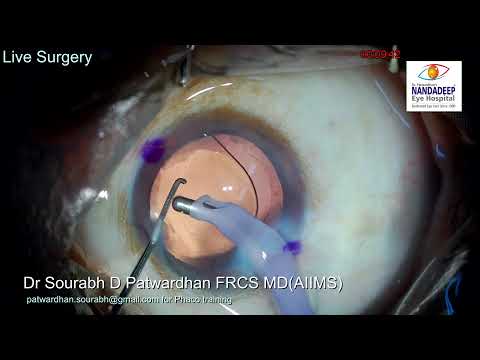 Brown cataract Broken phaco tip Live surgery from Nandadeep Eye Hospital Dr Sourabh Patwardhan