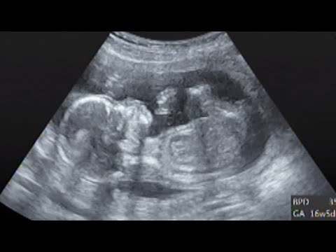 エコー 16w妊娠5ヶ月 4d お腹の中で鼻をかきかきする赤ちゃん Youtube