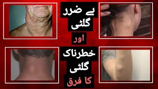 Tumor Lump Gilti Ganth Kia Hoti Hai Kyun Hoti Hai Gilti Khatam Karne Ka Tariqa Part 1