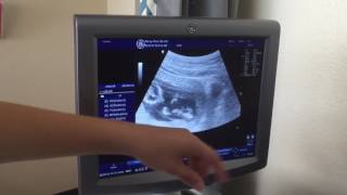 Ultrasound 13 weeks 0 day 13 Weeks Sonogram
