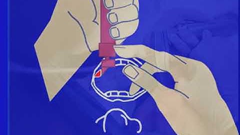 p.107. Entire Intubation Sequence Using the Macintosh Blade