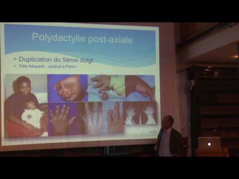 Vidéo: Pourquoi la polydactylie est-elle un trait dominant ?