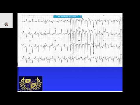 ecg-quiz-with-explanation-and-answers-2