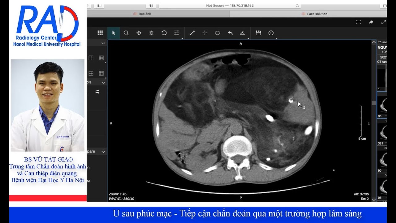 U sau phúc mạc - Tiếp cận chẩn đoán qua một trường hợp lâm sàng