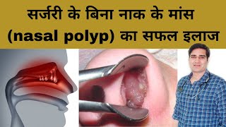 Nasal polyps treatment | nasal polyps homeopathic medicine | naak ka mass badhane ka ilaj