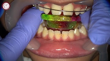step by step Growth modification by activator in orthodontics by Dr. Amr Asker