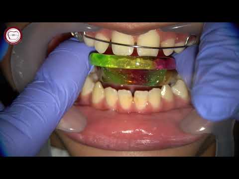 step by step Growth modification by activator in orthodontics by Dr. Amr Asker