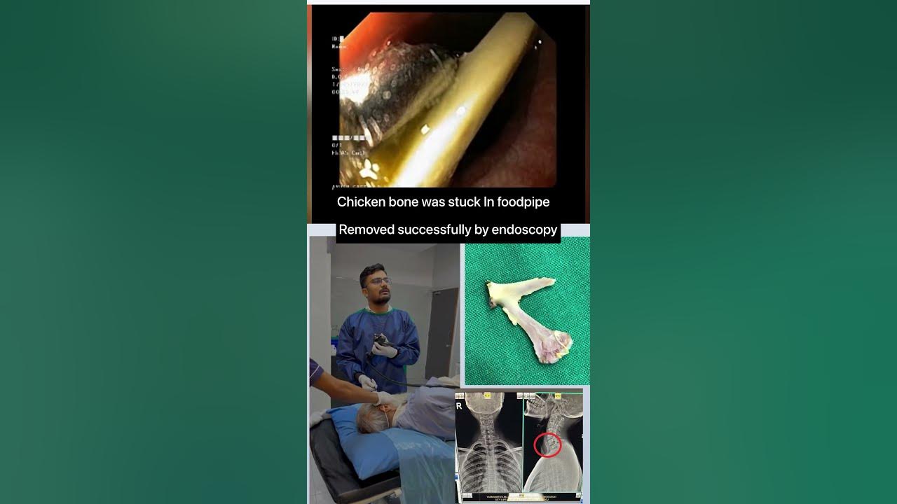 a-case-swallowed-a-chicken-bone-which-was-stuck-in-food-pipe-bone-was