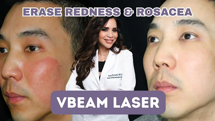 Erase Redness & Rosacea with VBeam Laser!