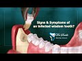 What are the Signs, Symptoms, and Treatment for Impacted wisdom teeth ?