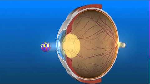 Cataract Formation