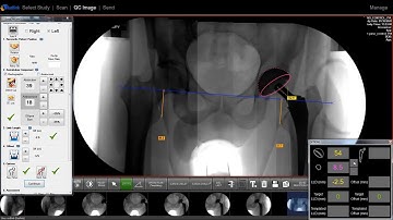 Intra-Operative Templating for Surgeon