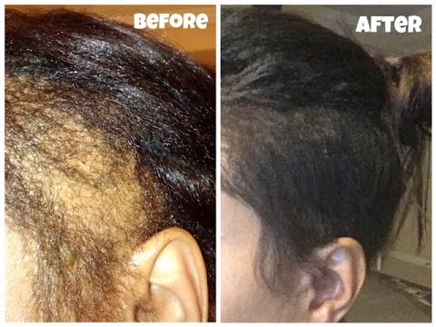 HELP TO REVERSE ALOPECIA | CW HAIRCARE | NATURAL HAIR GROWTH PRODUCTS ...
