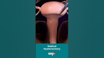 Radical Hysterectomy Treatment ↪ 3D Medical Animation #Shorts #RadicalHysterectomy #Hysterectomy