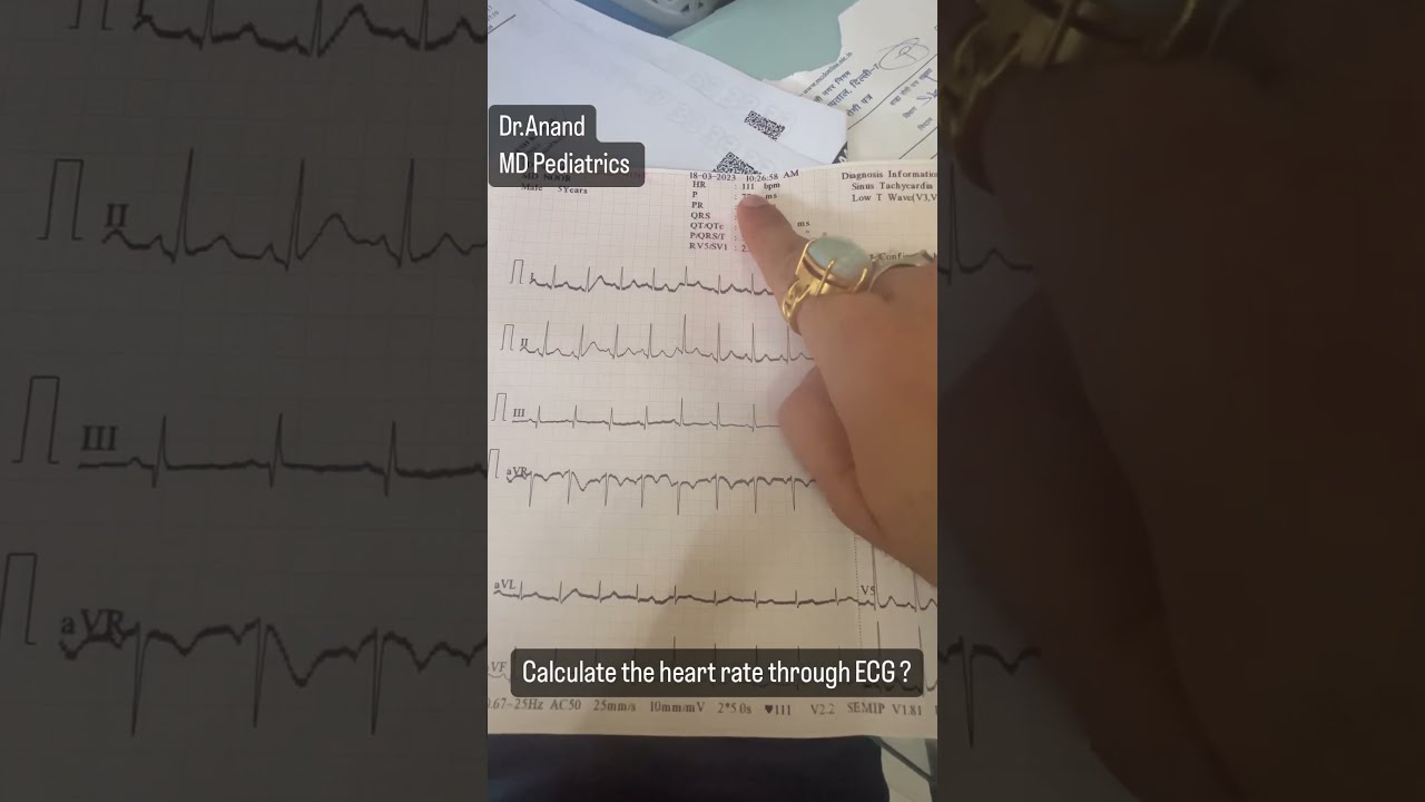 How To Calculate Heart Rate Through ECG Pediatrics Clinicalpediatrics Cerebellum