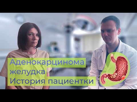 Рак желудка и пищевода - история пациентки | Аденокарцинома