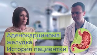 Рак желудка и пищевода - история пациентки | Аденокарцинома