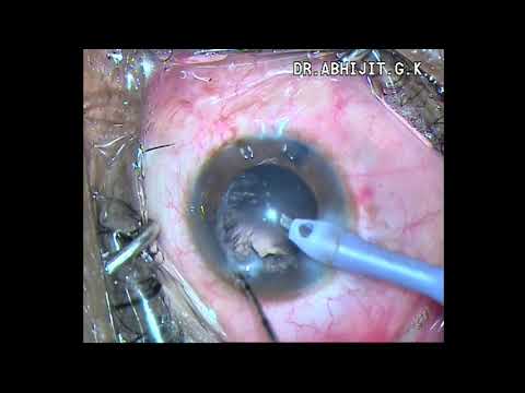Soft mature cataract
