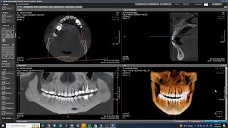 Pasos  para ver ver tomografías en CDViewer screenshot 1