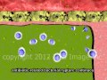 Bacterial Meningitis Antibiotic Therapy video - Animation by Cal Shipley, M.D.