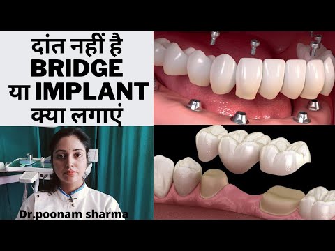 नकली या Artificial दांत कौन से लगवाएं? Bridge या Implant कौन सा है best|Bridge ya implant kya lagaye