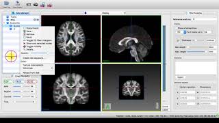 MI-Brain - Anatomical Maps Layering