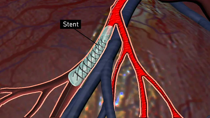 What's a stent?