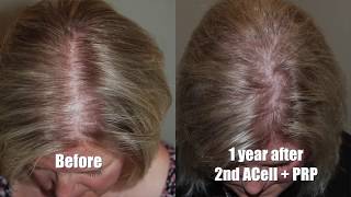 Non Surgical Alternatives for Hair Restoration - Northwest Hair Restoration