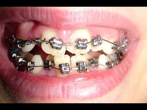 Vídeo: Como limpar dentes com aparelho: 12 etapas (com fotos)