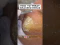 DIY DRY CRACKED HEELS 2022 | HOW TO TREAT CRACKED HEELS FULL TREATMENT BY MISS FOOT FIXER