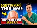 Doctor Reveal: Never Ignore These 5 Dangerous Changes on Your Nails After 60