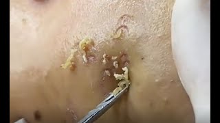 Acne Clear   Blackheads Removal   Beauty Care Video