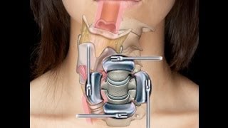 Cervical Spine Surgery (ACDF)  Swallow & Voice Problems