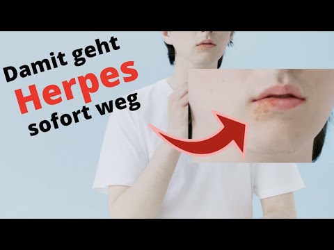 Herpes loswerden, funktioniert 💯 (nach jahrerlanger Leidensgeschichte, endlich die Lösung)