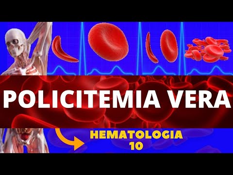 POLICITEMIA VERA (DOENÇA MIELOPROLIFERATIVA) - HEMATOLOGIA