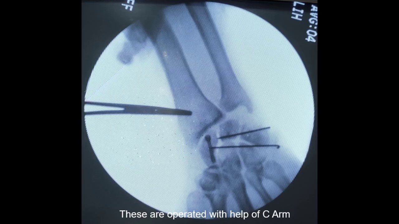 Transcaphoid Perilunar dislocation of wrist Outcome