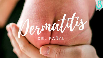 ¿Las toallitas de bebé pueden provocar dermatitis del pañal?