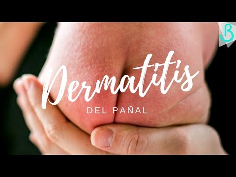 Video: Dermatitis Del Pañal: Tratamiento, Síntomas Y Causas