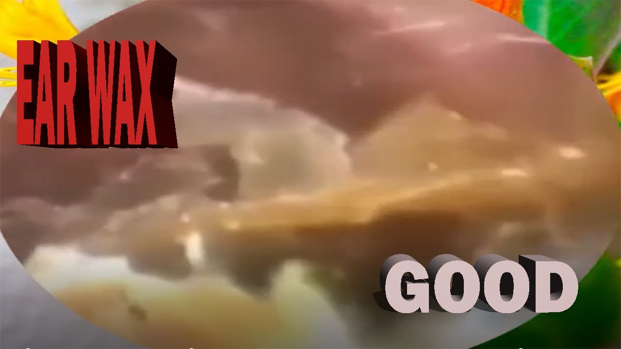 THE BIGGEST PIECE OF EAR WAX REMOVED...EVER! .ear wax removal EP125 YouTube