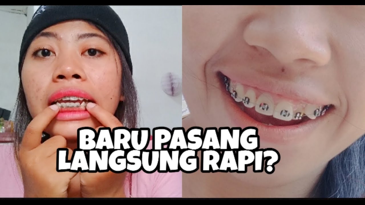 BARU PASANG BEHEL GIGI LANGSUNG RAPI  YouTube