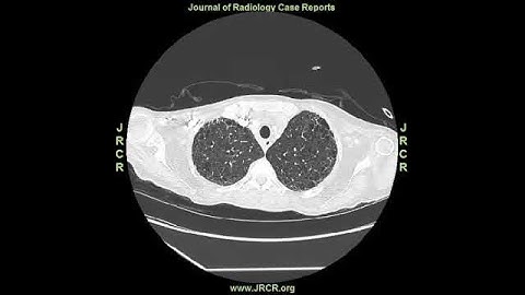 Radiology video: Cavitating Lung Lesions in Chronic Thromboembolic Pulmonary Hypertension