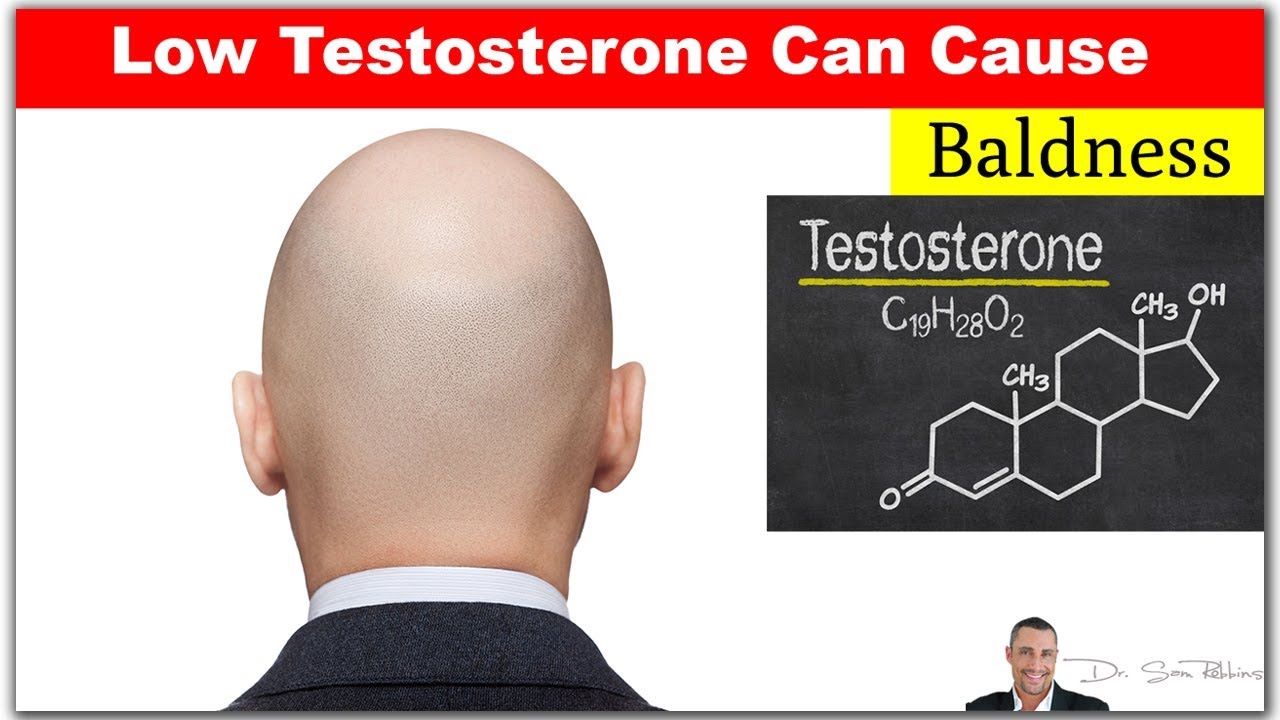 Low Testosterone Can Cause Hair Loss Or Balding Hair